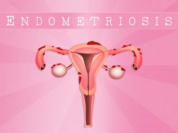 Juan-Rivero-Ginecologo-en-Mexico-Especialista-en-Endometriosis-002-compressor